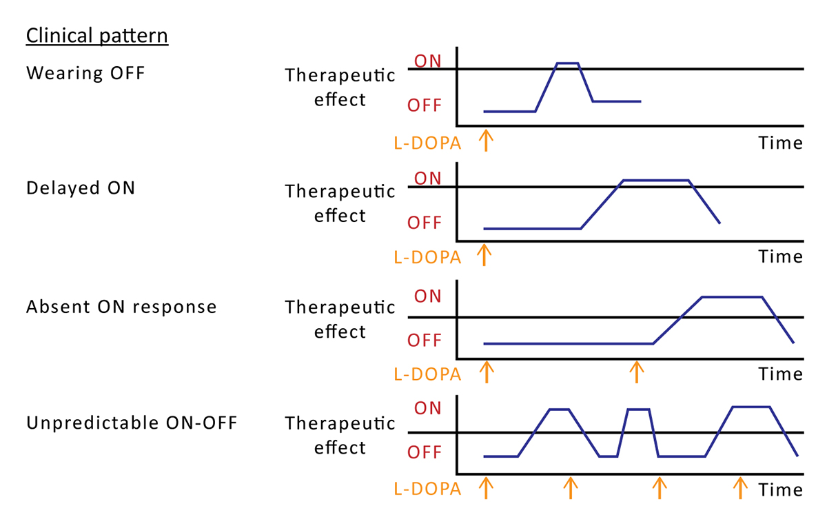 Chart showing effects of varying plasma levodopa concentrations on motor fluctuations in levodopa-treated Parkinson's disease