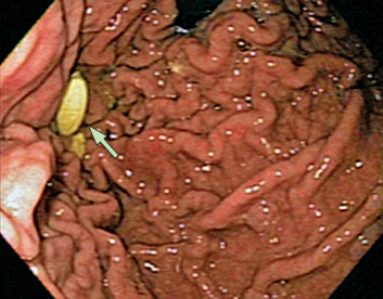 Gastroscopy image showing delayed gastric emptying, with levodopa pill still intact in the stomach 1.5 hours after intake.